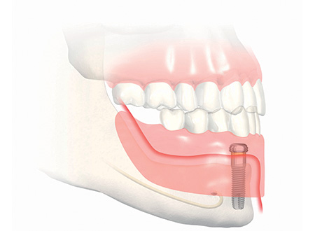 Implant dentaire Ivry-sur-Seine